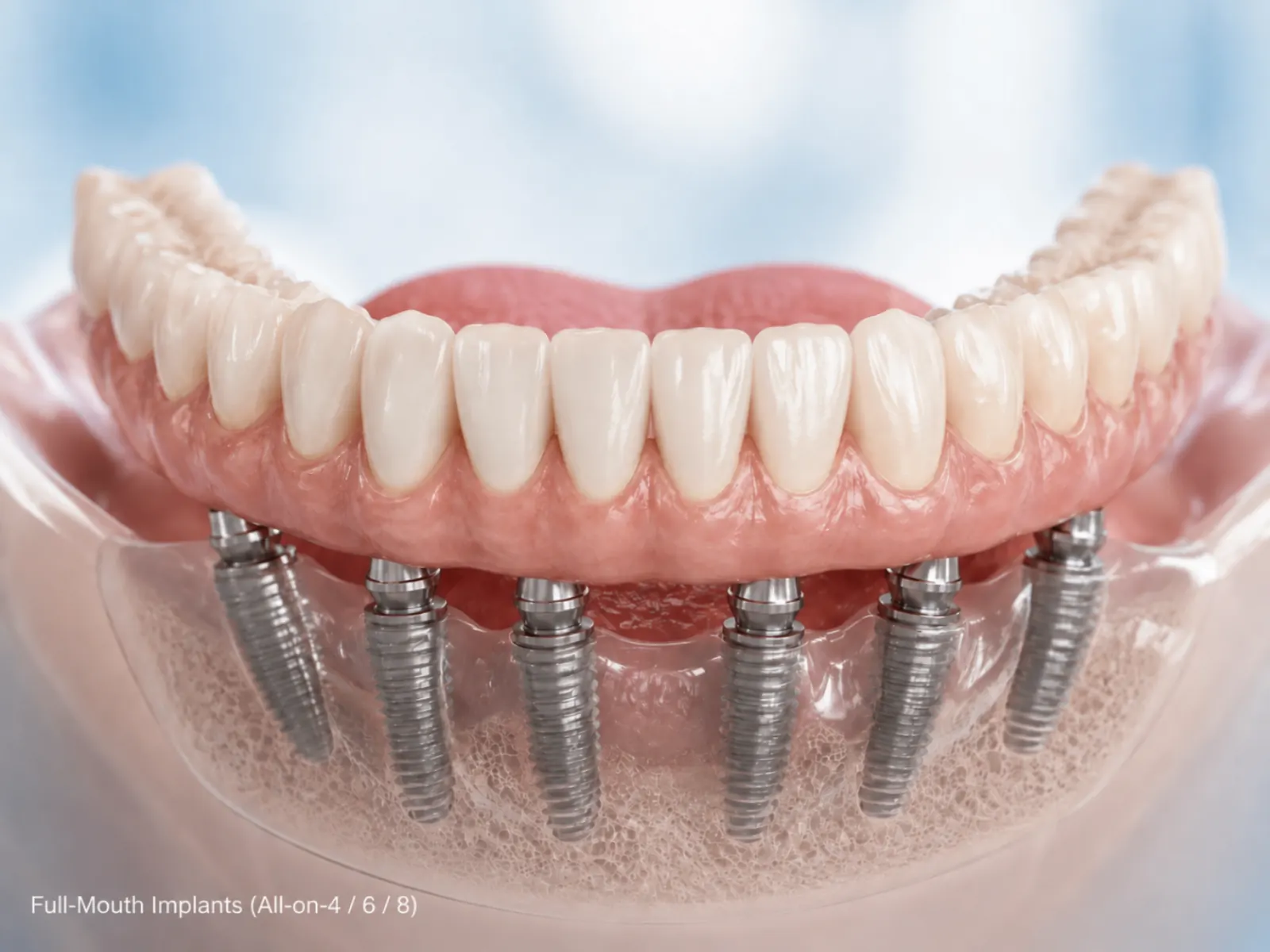 Full-mouth implants (All-on-4 / 6 / 8)